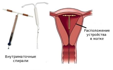 Почему болят бока внизу живота 2