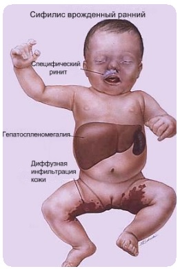 Диагностика и профилактика врожденного сифилиса 2
