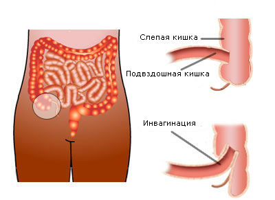 Инвагинация кишечника у детей: причины, симптомы, лечение2