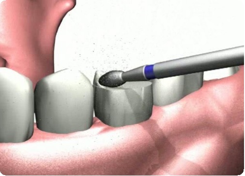 Препарирование зуба: показания, этапы, методы, последствия2