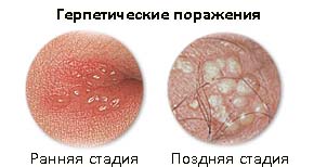 Генитальный герпес у мужчин и женщин: симптомы, лечение2