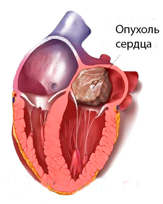 Злокачественная опухоль сердца2