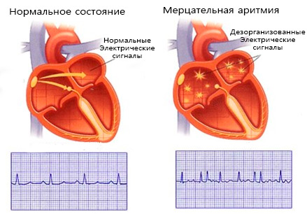Последствия мерцательной аритмии: рекомендации врачей, лечение2