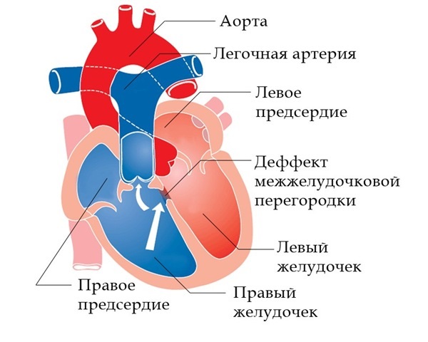Диагностика тетрады Фалло. Дифференциальная диагностика патологии2