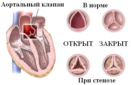 Надклапанный стеноз аорты. Синдром Williams2