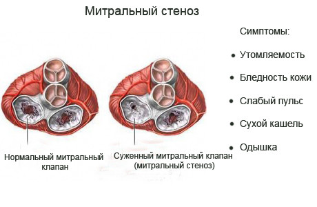 Митральный стеноз: симптомы, диагностика, лечение, последствия2