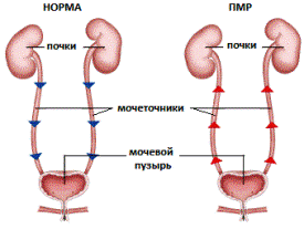 Пузырно-мочеточниковый рефлюкс у детей. Эндоскопическая коррекция пузырно-мочеточникового рефлюкса у детей2