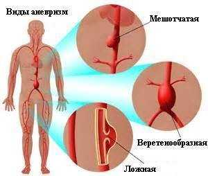 Аневризма аорты брюшной полости: операция, симптомы, лечение2