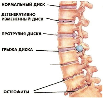 Позвоночная грыжа: лечение, поясничного отдела, симптомы, операция2