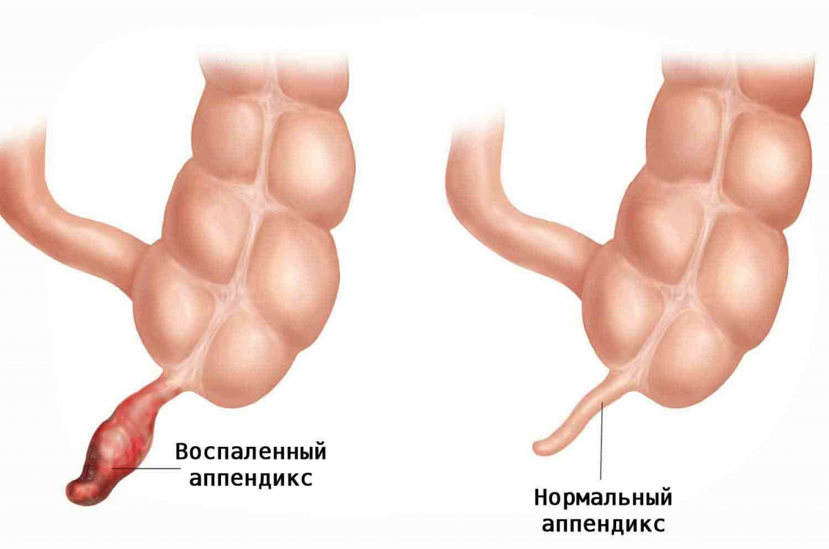 Аппендицит: признаки и симптомы, лечение, осложнения, фото, видео2