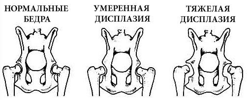 Дисплазия тазобедренного сустава у новорожденных: лечение, фото и ведео  2