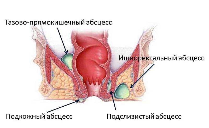 Парапроктита: лечение, операция, фото, симптомы, без операции, свищ2