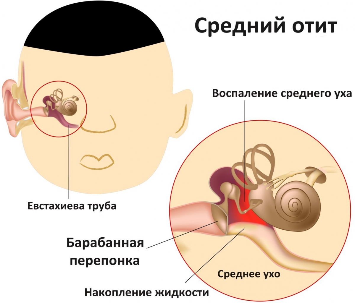 Болит ухо, что  делать в домашних условиях? 2