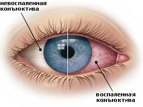 Конъюнктивит у детей: лечение, симптомы,  профилактика, фото2