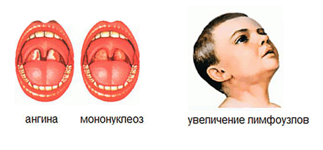 Токсоплазмоз у человека: симптомы, лечение3