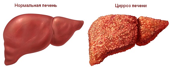 Болит печень, что делать?3