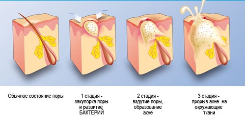 Программа по борьбе с акне3