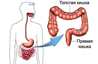 Дивертикулез кишечника: симптомы, осложнения, лечение3