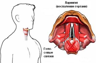 Сел голос, горло не болит, что делать?3