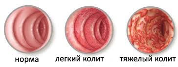 Колит кишечника: симптомы, лечение у взрослых3