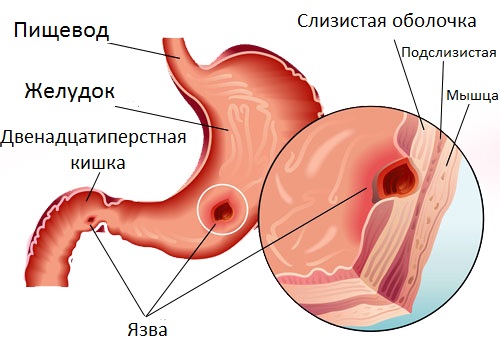 Язва желудка: симптомы, лечение, народные средства3
