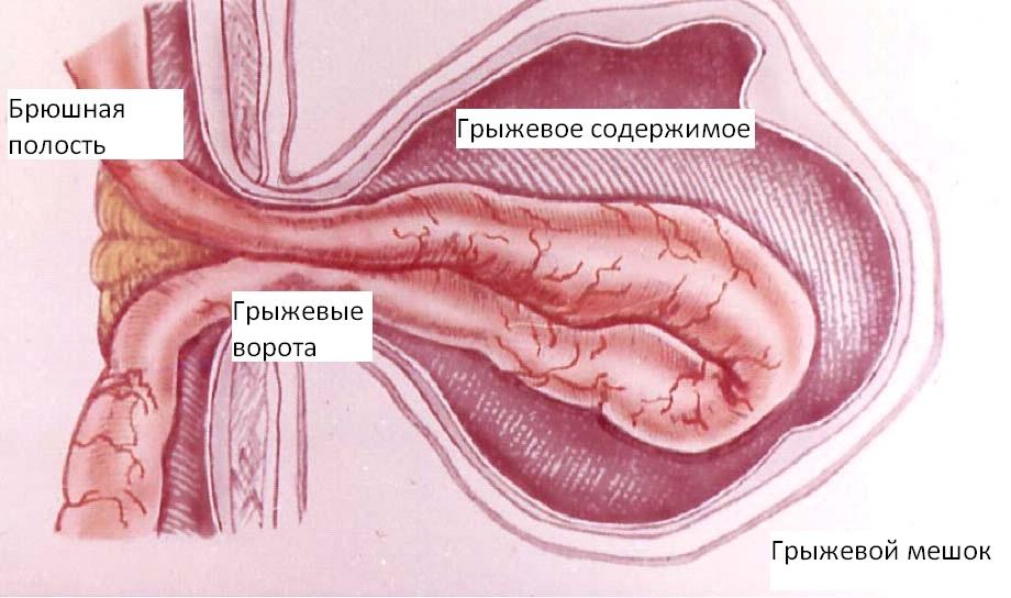 Паховая грыжа у мужчин симптомы, осложнения, лечение, фото3