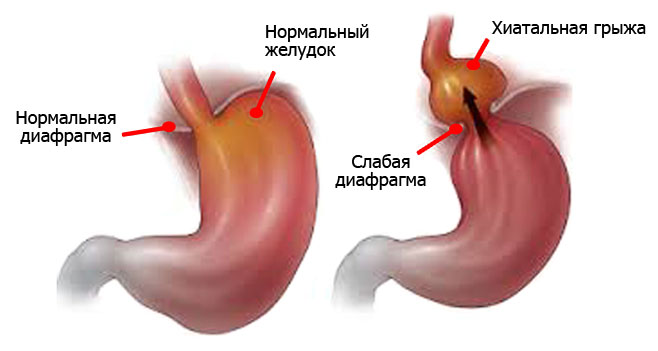 Грыжи пищевода: симптомы, лечение, диагностика, операция, фото3
