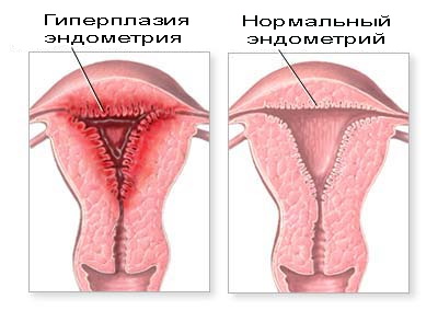 Гиперплазия эндометрия: симптомы, лечение, отзывы, фото3