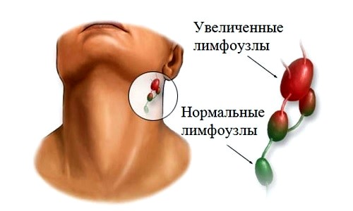Болезнь Чагаса (Шагаса): симптомы, лечение3