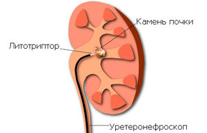 Двусторонний нефролитиаз у детей3