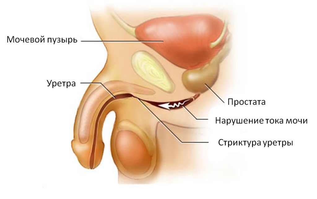Осложнения гонореи у женщин и у мужчин3