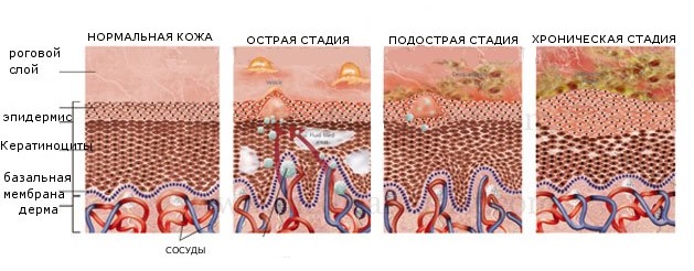 Происхождение экземы: причины, стадии лечения, диагностика, фото3