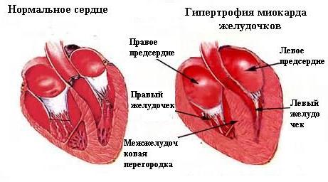 Острая сердечно-сосудистая недостаточность у детей 3