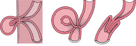 Пневмококковый перитонит у детей: симптомы, причины, лечение, осложнения3