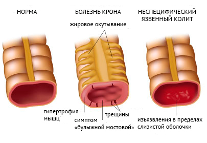 Язвенный колит: симптомы, лечение: болезнь и диета3