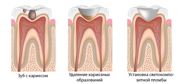 Резорбция корня: причины, симптомы, профилактика, лечение, последствия3