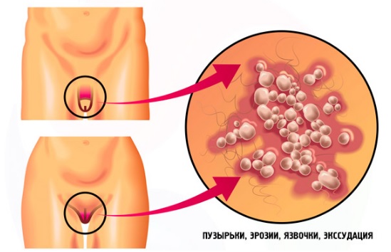 Генитальный герпес у мужчин и женщин: симптомы, лечение3