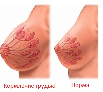 Лактостаз: причины, симптомы, лечение3