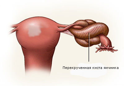Киста яичника: симптомы, лечение, операция3