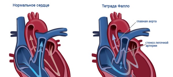 Лечение тетрады Фалло: способы, этапы, рекомендации врачей3
