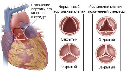 Клапанный стеноз аорты: диагностика, лечение, рекомендации врачей3