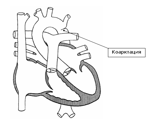 Коарктация аорты: операция, этапы, последствия3