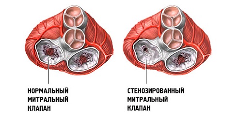 Митральный стеноз: симптомы, диагностика, лечение, последствия3