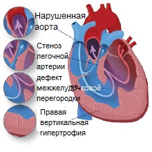 Диагностика тетрады Фалло. Дифференциальная диагностика патологии3