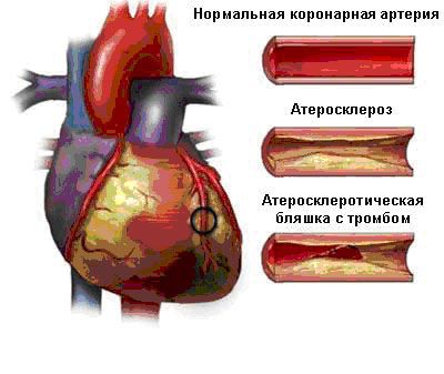 Повышенный холестерин в крови: причины, диета, что делать и как лечить?4