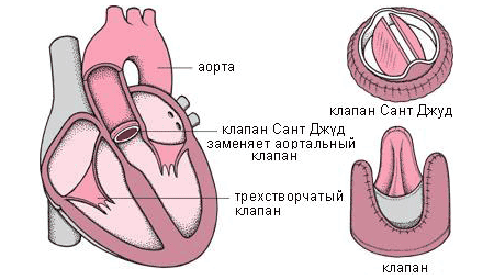 Клапанный стеноз аорты: диагностика, лечение, рекомендации врачей4