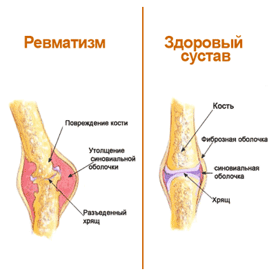 Болят суставы, что делать?4