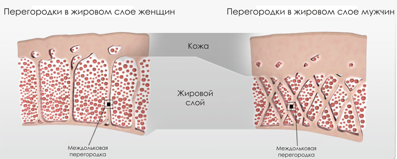 Целлюлит: причины, лечение в домашних условиях, фото4