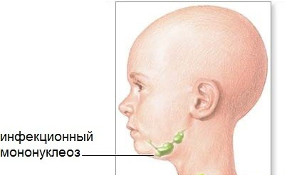 Экзема начальная стадия: лечение, фото, на руках и ногах4