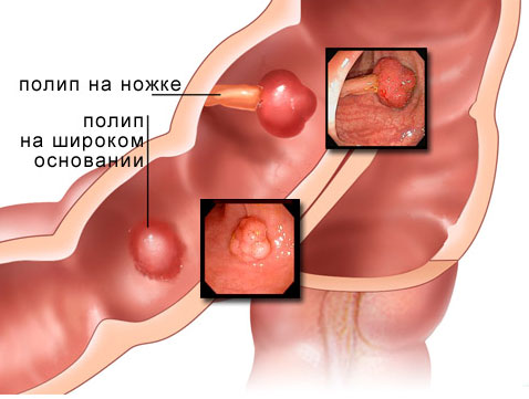 Дивертикулез кишечника: симптомы, осложнения, лечение4